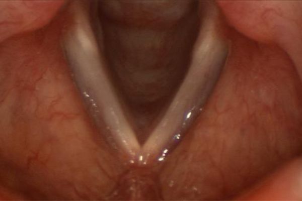 Ressecção de pólipos e tumores das cordas vocais